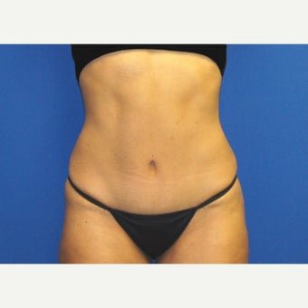 53 year old woman treated with Mini Tummy Tuck and Contour Liposuction after 1588613
