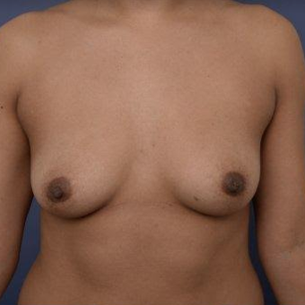 29 year old woman treated with Breast Augmentation before 3670116