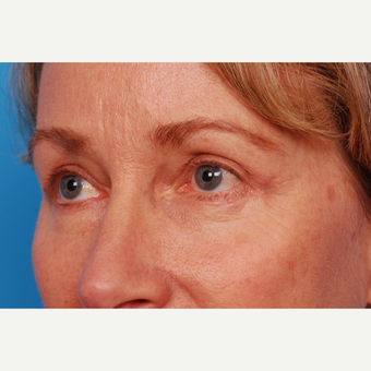 55-64 year old woman treated with Eyelid Surgery after 2995466