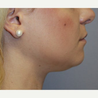 18-24 year old woman treated with Chin Liposuction and Small Chin Implant before 1651137