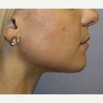 18-24 year old woman treated with Chin Liposuction and Small Chin Implant after 1651137