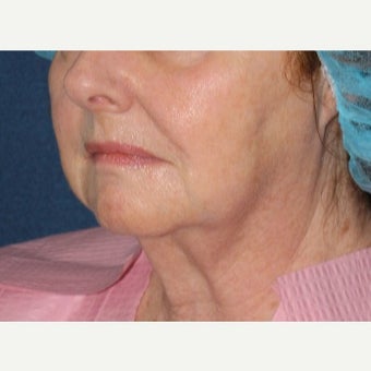 55-64 year old woman treated with Fraxel Laser 1628320