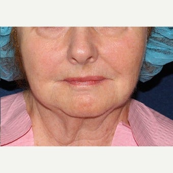 55-64 year old woman treated with Fraxel Laser after 1628320