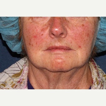 55-64 year old woman treated with Fraxel Laser before 1628320