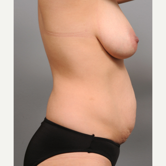 35-44 year old woman treated with Mommy Makeover before 3669136