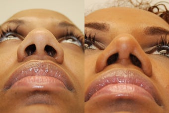African Rhinoplasty Surgery. 1 month post-op. before 754371