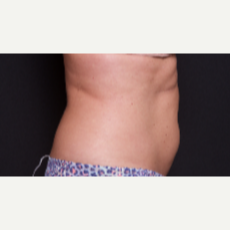 45-54 year old woman treated with SculpSure after 3646516