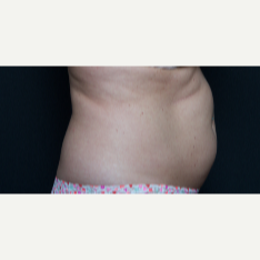 45-54 year old woman treated with SculpSure before 3646516