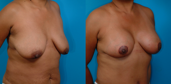39-year-old woman treated with a Mommy Makeover. before 1058379