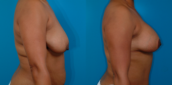 39-year-old woman treated with a Mommy Makeover. after 1058379