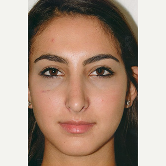17 or under year old man treated with Rhinoplasty after 3406269