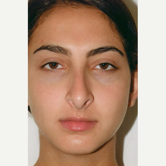 17 or under year old man treated with Rhinoplasty before 3406269
