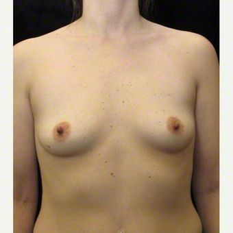 28 year old woman treated with Breast Augmentation before 3103622