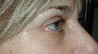 Upper Blepharoplasty, IPL after 277976