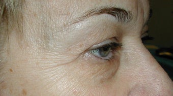 Upper Blepharoplasty, IPL before 277976