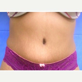 45-54 year old woman treated with Tummy Tuck after 1838731