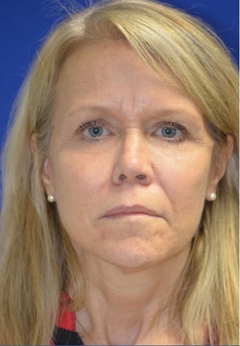 Facelift/Necklift with Fat grafting. Dr. Levesque after 3494897