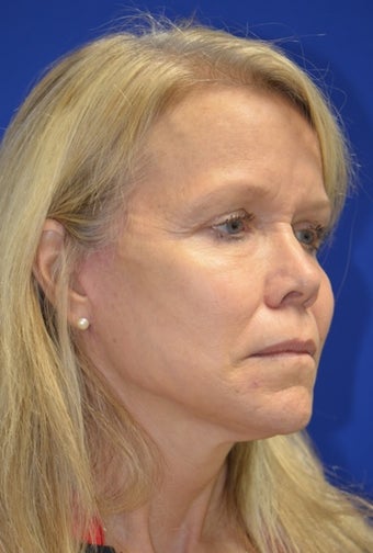 Facelift/Necklift with Fat grafting. Dr. Levesque 3494897