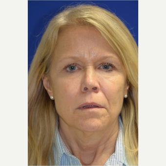 Facelift/Necklift with Fat grafting. Dr. Levesque before 3494897