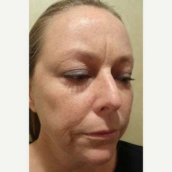 45-54 year old woman treated with Radiesse before 3749271