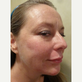 45-54 year old woman treated with Radiesse after 3749271