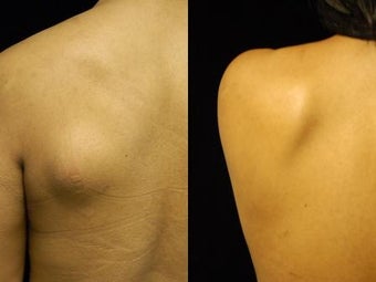 Smartlipo Triplex Lipoma Removal at Two Months after 837417