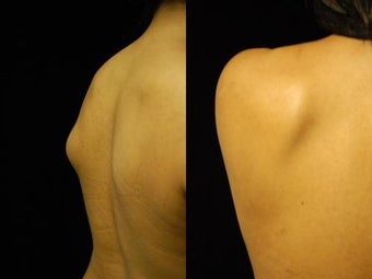 Smartlipo Triplex Lipoma Removal at Two Months before 837417