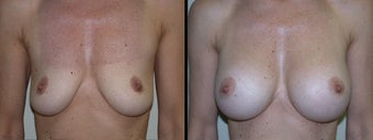 Breast Augmentation before 1231983