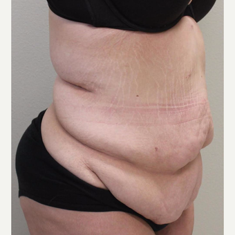 18-24 year old woman treated with Tummy Tuck before 3065909