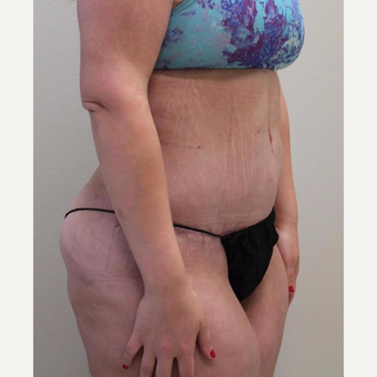 18-24 year old woman treated with Tummy Tuck after 3065909