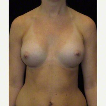 24 year old woman treated with Breast Augmentation for Asymmetry before 3103588