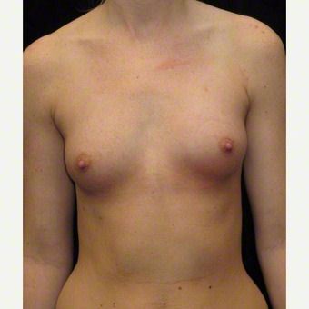 24 year old woman treated with Breast Augmentation for Asymmetry after 3103588