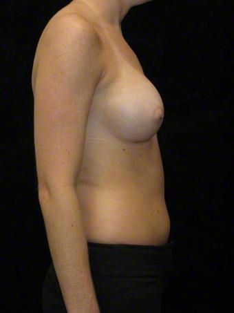 24 year old woman treated with Breast Augmentation for Asymmetry 3103588