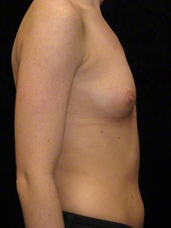 24 year old woman treated with Breast Augmentation for Asymmetry 3103588