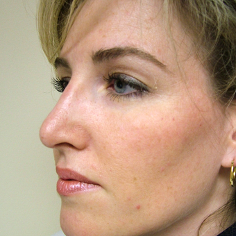 35-44 year old woman treated with Rhinoplasty after 3320873