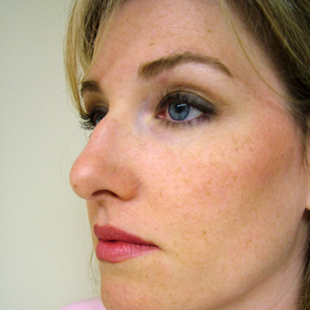 35-44 year old woman treated with Rhinoplasty before 3320873