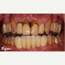 45-54 year old man treated with Dental Implants before 3577715