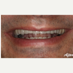 45-54 year old man treated with Dental Implants after 3577715