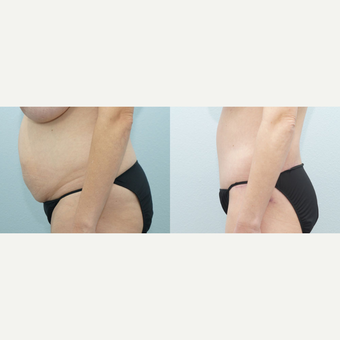 38 yr old Female - Body Lift and Breast Reduction after 3099794