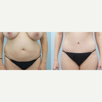 38 yr old Female - Body Lift and Breast Reduction before 3099794
