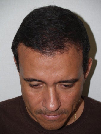 Hair Transplant - 3400 grafts after 207691