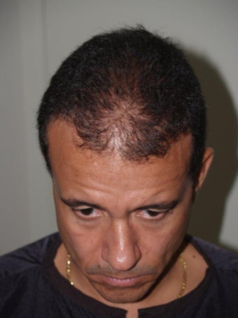 Hair Transplant - 3400 grafts before 207691