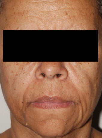 Female Patient Treated with Radiesse after 1044911