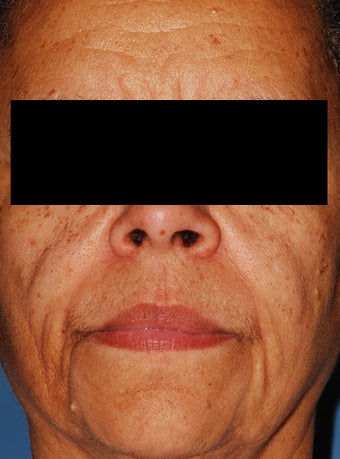 Female Patient Treated with Radiesse before 1044911