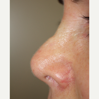 45-54 year old woman treated with Non Surgical Nose Job before 3706370