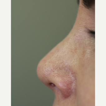 45-54 year old woman treated with Non Surgical Nose Job after 3706370