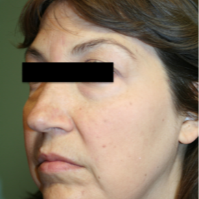 55-64 year old woman treated with Rhinoplasty before 3747703