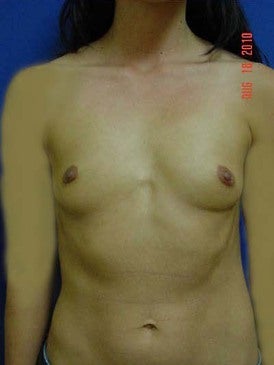 Breast Augmentation before 481484