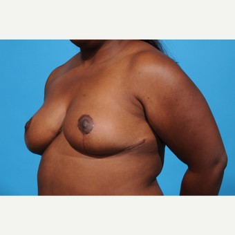 25-34 year old woman treated with Breast Reduction after 3777010