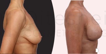 57 yr old woman, after weight loss, treated with augmentation mastopexy ( breast lift and implants) before 1122866
